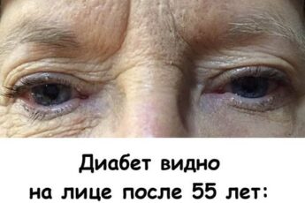 Диабет видно на лице после 55 лет: 7 признаков повышенного сахара. Рассказываю