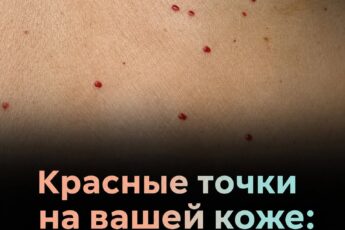 Если заметите на коже эти красные точки, лучше сразу разобраться, что они означают