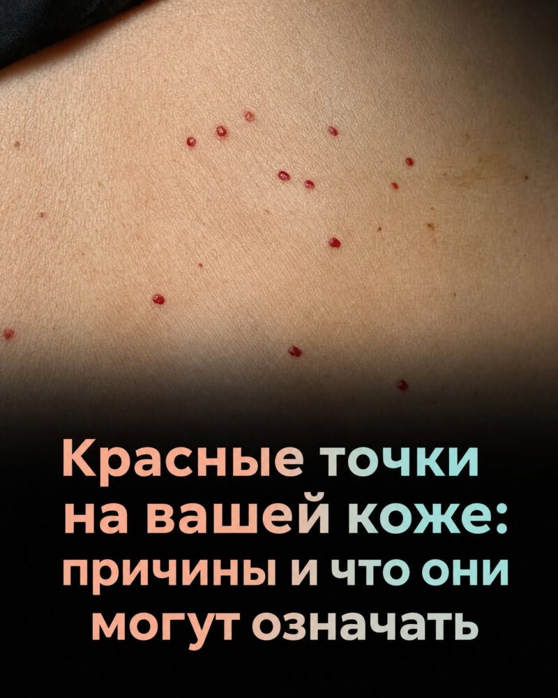 Если заметите на коже эти красные точки, лучше сразу разобраться, что они означают Если заметите на коже эти красные точки, лучше сразу разобраться, что они означают