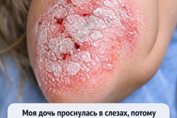 Моя дочь проснулась в слезах, потому что толстые серебристые чешуйки на её локтях потрескались и кровоточат. Её запись к дерматологу отменили, и...