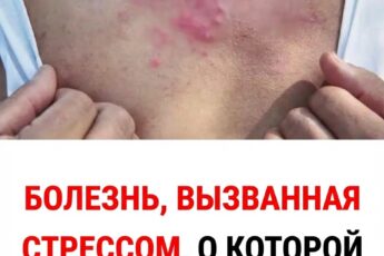 Похоже, что резкое снижение иммунной защиты, возможно, связанное с сильным психофизическим стрессом, может способствовать реактивации вируса.