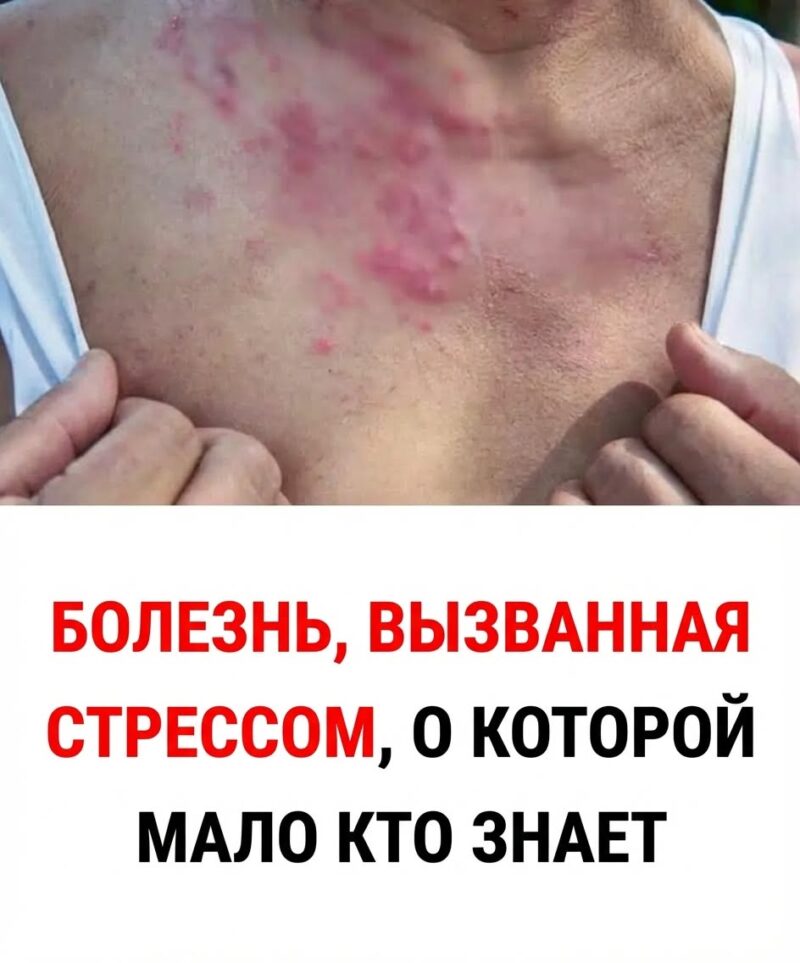 Похоже, что резкое снижение иммунной защиты, возможно, связанное с сильным психофизическим стрессом, может способствовать реактивации вируса. Похоже, что резкое снижение иммунной защиты, возможно, связанное с сильным психофизическим стрессом, может способствовать реактивации вируса.