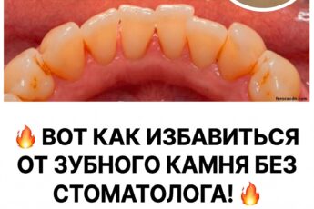 Способы безопасного удаления зубного камня в домашних условиях.