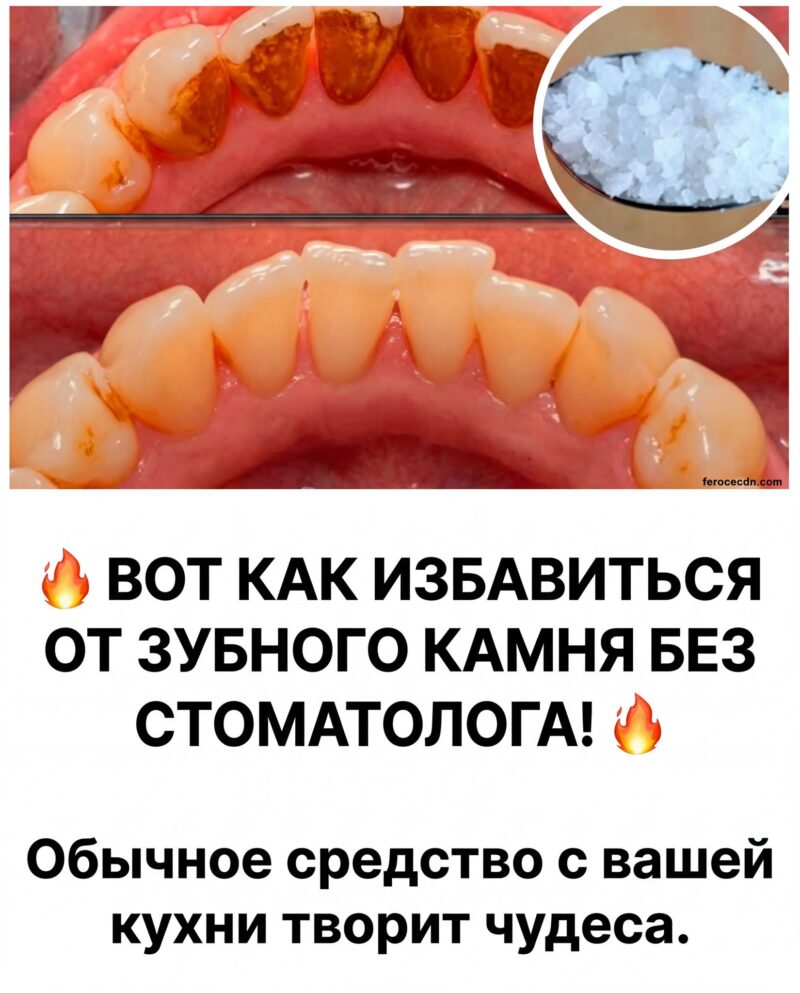 Способы безопасного удаления зубного камня в домашних условиях. Способы безопасного удаления зубного камня в домашних условиях.