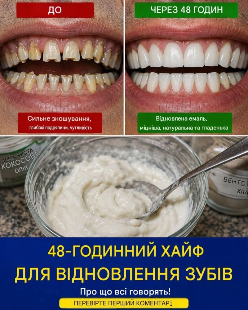Зубні виїмки на лінії ясен: причини, лікування чутливих зубів та як захистити свою посмішку