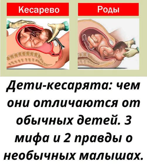 Узнайте всё о кесаревом сечении: когда назначают операцию, как проходит восстановление и какие мифы о таких родах стоит развеять будущим мамам. Узнайте всё о кесаревом сечении: когда назначают операцию, как проходит восстановление и какие мифы о таких родах стоит развеять будущим мамам.